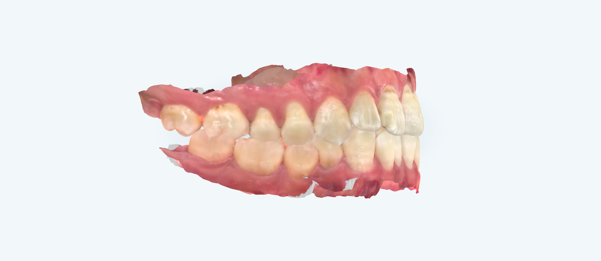 Crossbite treatment comparison case 1 before